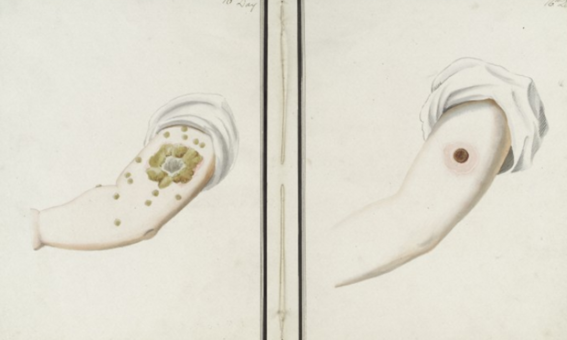 Resultate von Pocken- (links) und Kuhpocken-Inokulation (rechts) nach 16 Tagen [George Kirtland, 1802]