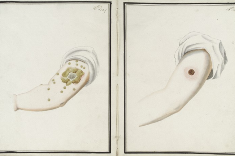 Resultate von Pocken- (links) und Kuhpocken-Inokulation (rechts) nach 16 Tagen [George Kirtland, 1802] 