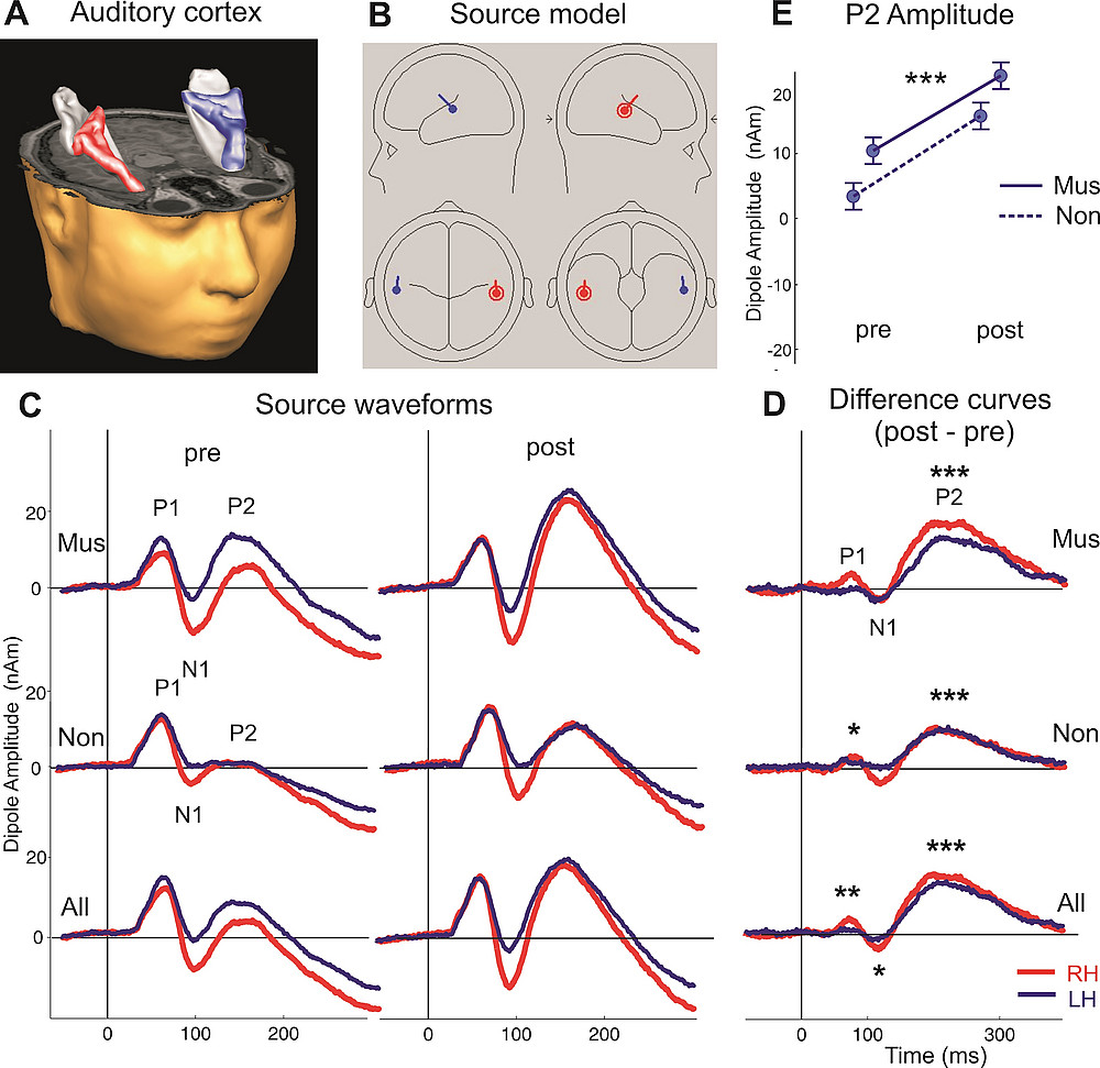 Three-dimensional reconstructions of the right and left auditory cortex ©Schneider, P., Groß, C., Bernhofs, V., Christiner, M., Benner, J., Turker, S., ... & Seither‐Preisler, A. (2022).