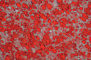 Schnittpräparat eines Herzmuskels. Da CGI-58 fehlt, kommt es zur Fettakkumulation (rot gefärbte Tröpfchen), sichtbar gemacht durch eine Färbelösung (SudanIII). Das Bild ziert auch das Cover der aktuellen Ausgabe des Journal of Biological Chemistry. F