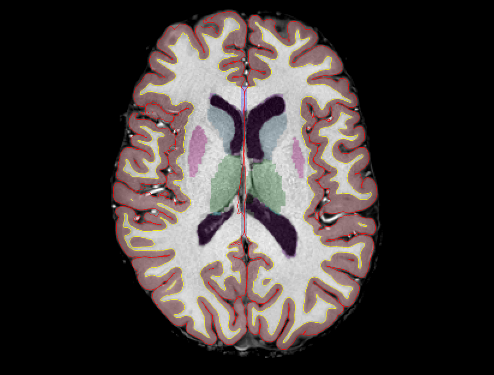 Gehirnausschnitt mit markierten Hirnregionen ©Natalia Zaretskaya