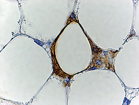 Eine weiß gewordene, ursprünglich braune Fettzelle (im Zentrum) stirbt und wird von Immunzellen (braune umgebende Struktur) aufgefressen. Foto: Uni Graz