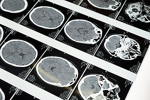 MRI Scan of Brain 