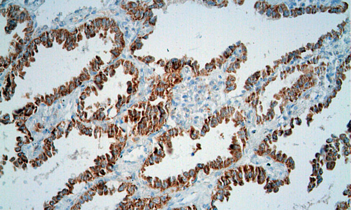 ForscherInnen haben herausgefunden, dass Vitamin B6 Chemotherapien im Kampf gegen Lungenkrebs unterstützt. Das Bild zeigt eine Biopsie mit Expression von Pyridoxalkinase, einem wichtigen Enzym zur Aktivierung von Vitamis B6. Foto: Lorenzo Galluzzi