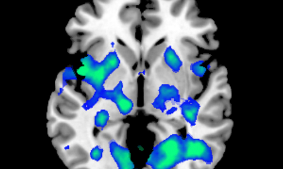 Durch den Placebo-Effekt nimmt die Aktivität in bestimmten Regionen des Hirns ab. Als Folge dieser positiven Suggestion zeigten sich Probandinnen weit weniger angeekelt als vor der vermeintlichen Therapie.