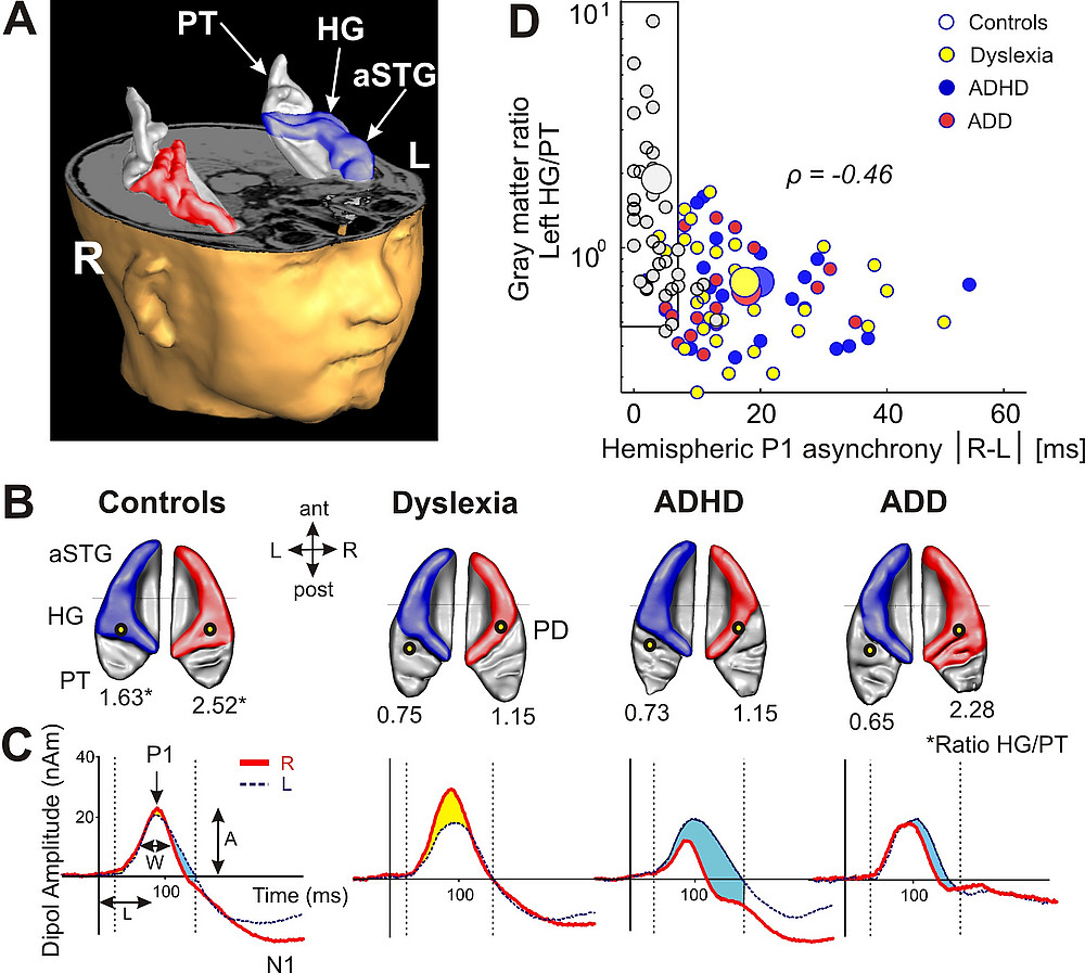 Fig. 2 ©Serrallach, B., Groß, C., Bernhofs, V., Engelmann, D., Benner, J., ….. Parncutt, R., Schneider, P. & Seither-Preisler, A. (2016)