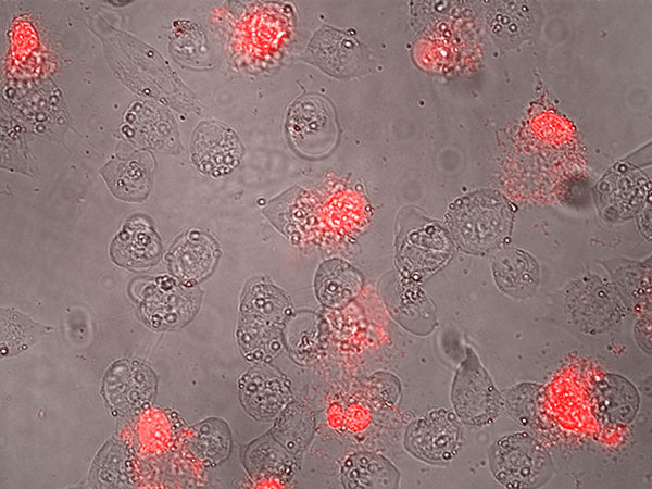 Mit dem Antitumor-Peptid behandelte Hautkrebszellen: Auf Bläschenbildung folgen starke Membranschädigungen und Zelltod (rot). Foto: Uni Graz/Riedl 