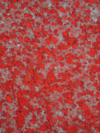 Schnittpräparat eines Herzmuskels. Da CGI-58 fehlt, kommt es zur Fettakkumulation (rot gefärbte Tröpfchen), sichtbar gemacht durch eine Färbelösung (SudanIII). Das Bild ziert auch das Cover der aktuellen Ausgabe des Journal of Biological Chemistry. F 